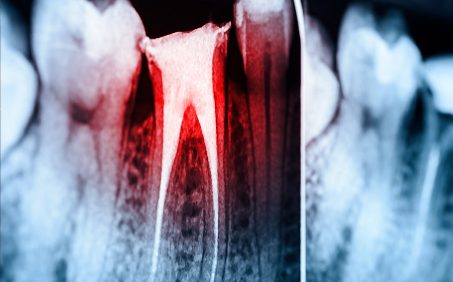 endodontie wurzelbehandlung muenchen innenstadt stachus
